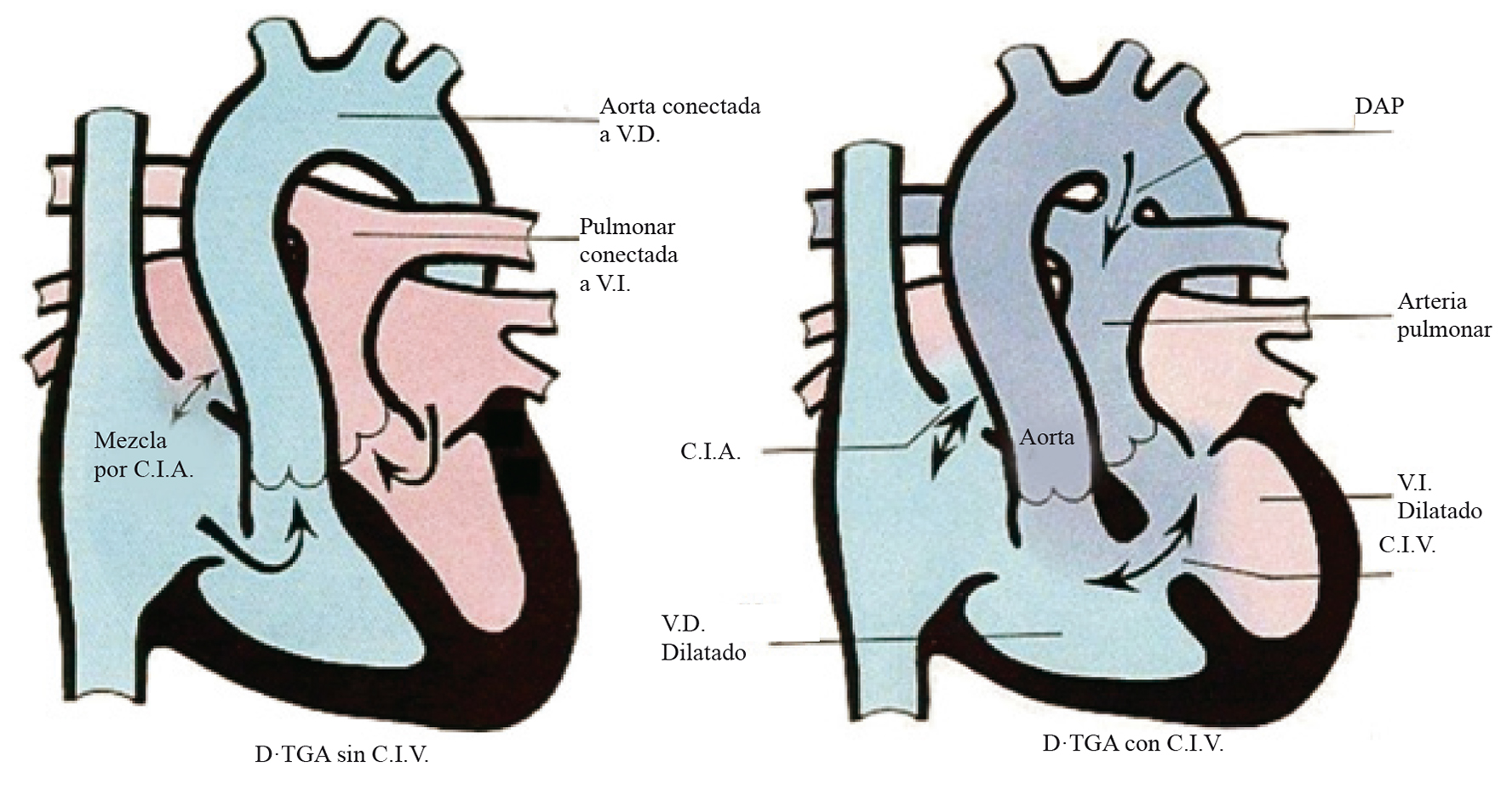 CARDIOPATÍA CONGÉNITA CIANÓTICA Y ANESTESIA - Revista Chilena de Anestesia