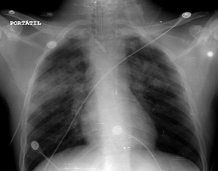 radiografía de edema pulmonar