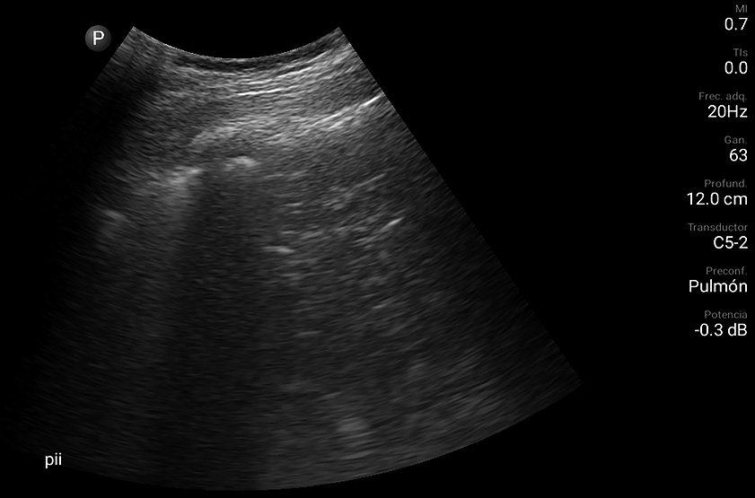 Perioperative pain management in abdominoplasty - Revista Chilena