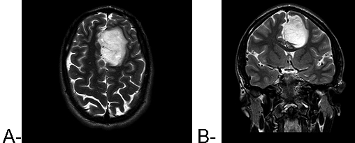 cerebro plano axial