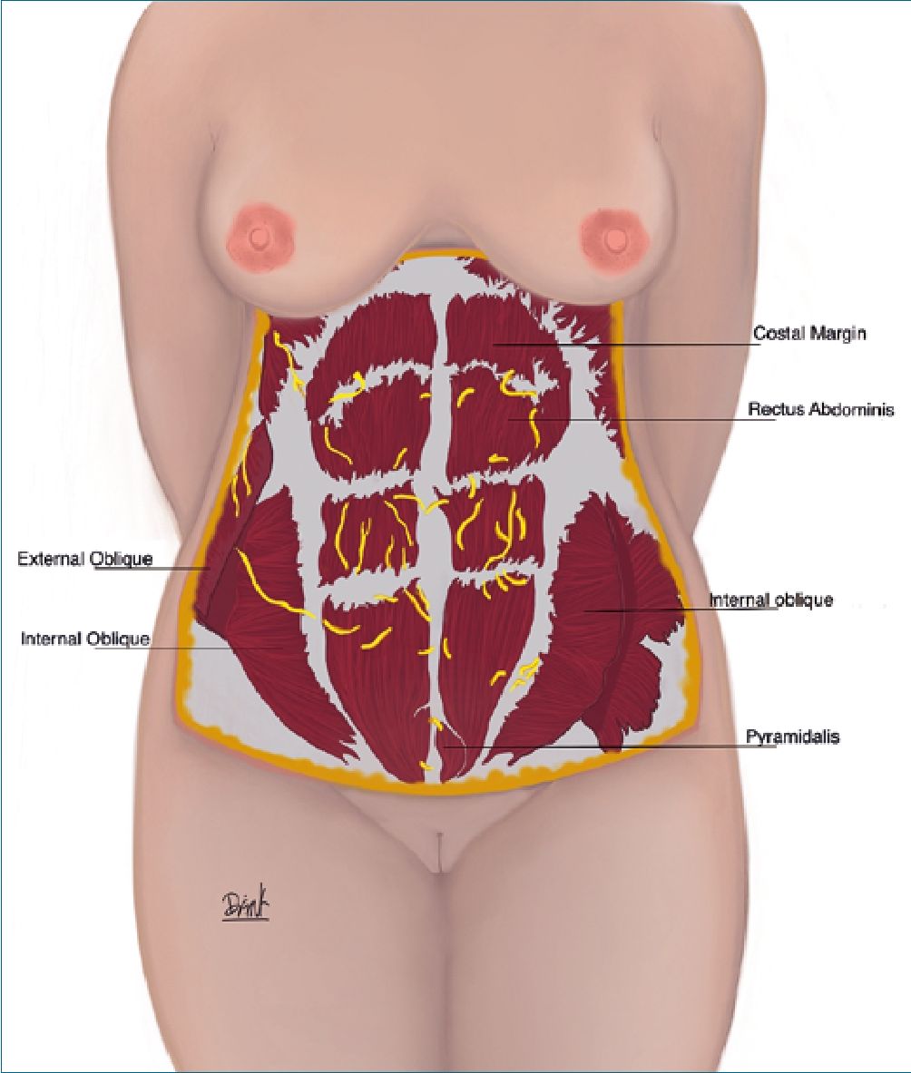 Body FX - Client has Diastasis Recti, also known as abdominal